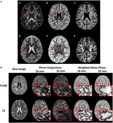 Advanced diffusion MRI and image texture analysis detect widespread brain structural differences between relapsing-remitting and secondary progressive multiple sclerosis